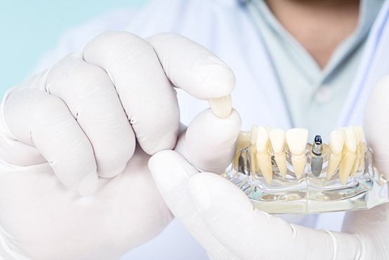 Dental implant model held in gloved hands